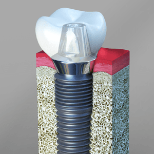 Dental Implants Midland